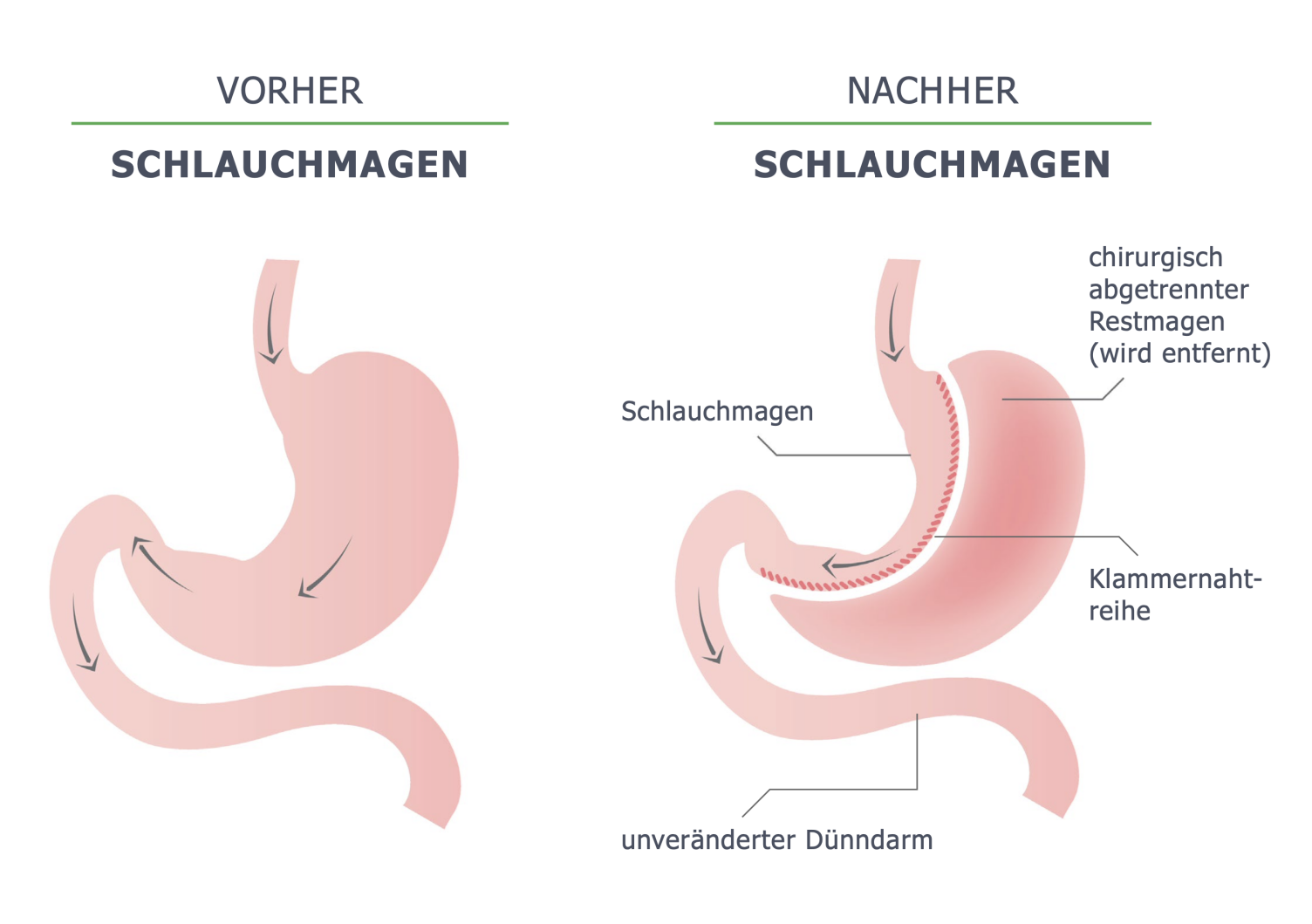 Medizinische Probleme nach Magenbypass